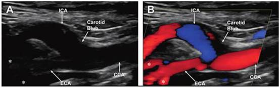 正確的電源穩(wěn)壓器能最大限度地減少直流電軌噪聲并提高超聲圖像的質量 正確的電源穩(wěn)壓器能最大限度地減少直流電軌噪聲并提高超聲圖像的質量